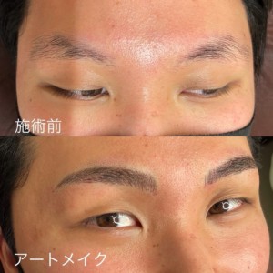 アートメイク症例